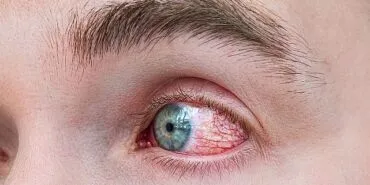 Bahar Alerjisinde Göz Ovalamak Körlüğe Yol Açıyor haberi