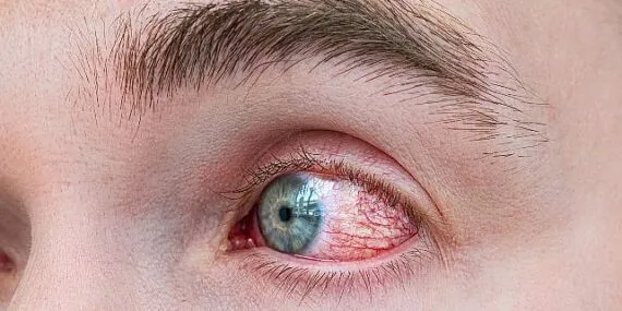 Bahar Alerjisinde Göz Ovalamak Körlüğe Yol Açıyor haberi