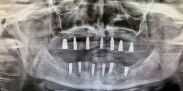 Bayburt Ağız ve Diş Sağlığı Merkezinde 13 İmplantlık Başarılı Ameliyat