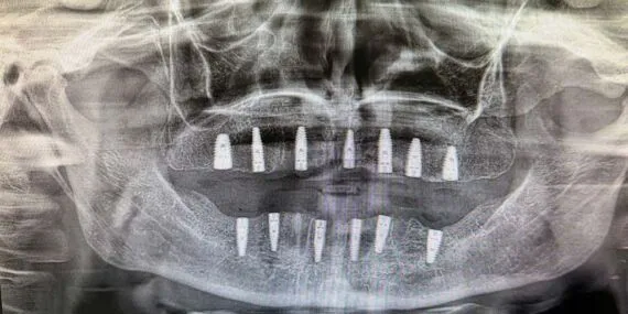 Bayburt Ağız ve Diş Sağlığı Merkezinde 13 İmplantlık Başarılı Ameliyat