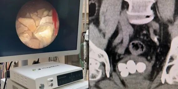 Bayburt’ta 84 Yaşındaki Hastaya İki Ayrı Başarılı Kapalı Ameliyat Yapıldı